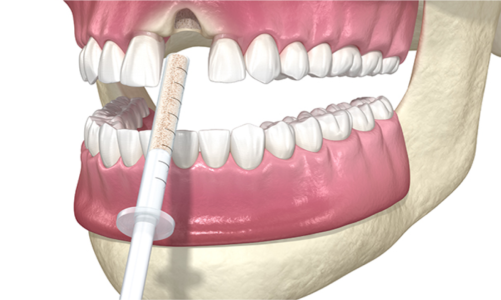 잇몸뼈 이식
