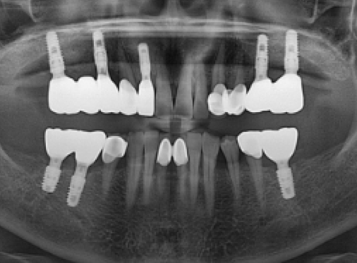 임플란트 후 x-ray